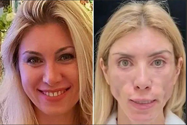 Суд взыскал 3 млн рублей в пользу модели из Сочи, которая не может моргать и улыбаться после пластики