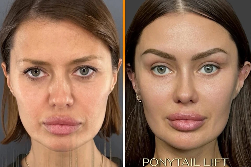 Пластический хирург Чио Чи Као перечислил операции Виктории Бони на лице